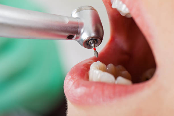 Best Emergency Wisdom Teeth Removal in Tamalpais Homestead Valley, CA